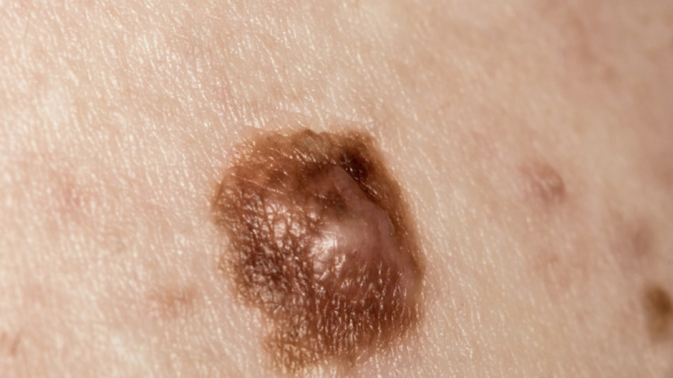 Melanoma, immunoterapia locale uccide tumore e recluta cellule