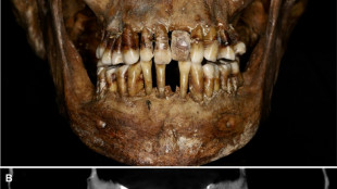 La dentition d'une aristocrate du XVIIe siècle comme marqueur social