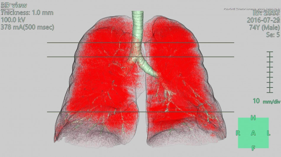 Australia proibisce uso della pietra composita, provoca silicosi